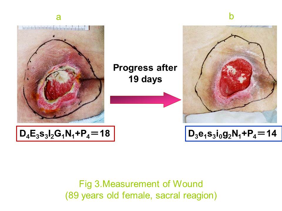 Fig 2. Measurement of Wound (89 years old female, sacral reagion)